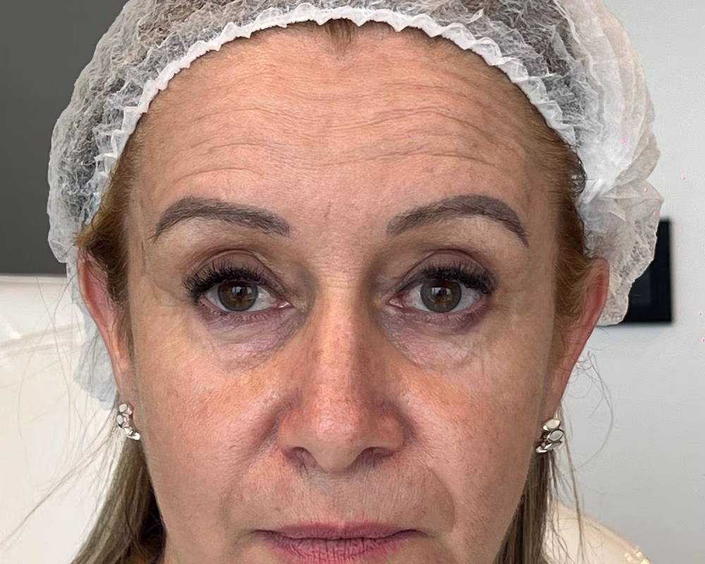 armonización facial