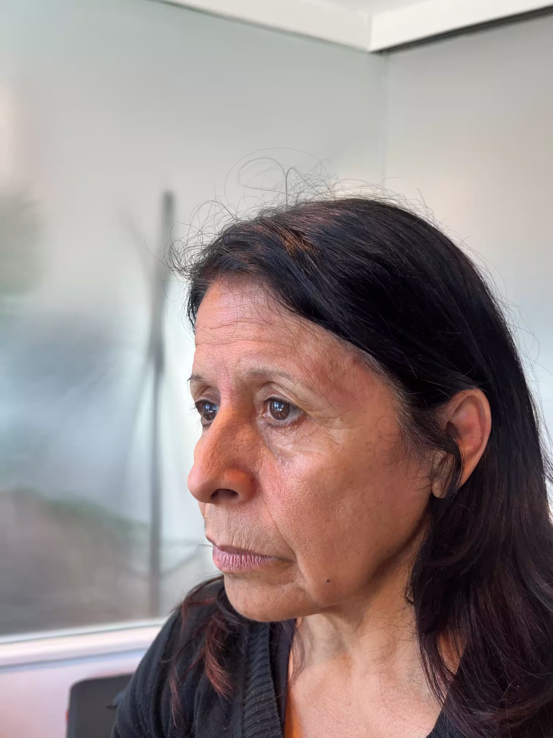 hilos tensores facial en montevideo antes y despues