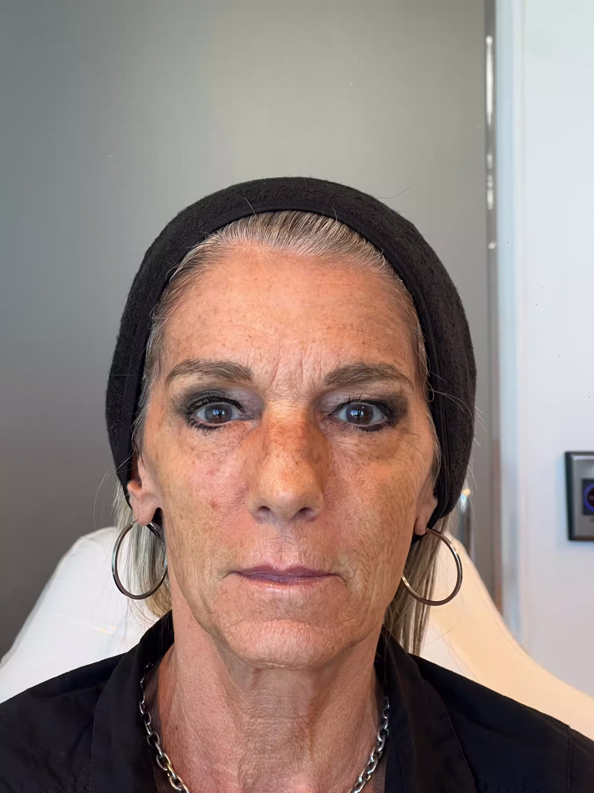 lifting facial con acido hialuronico natural hombres y mujeres
