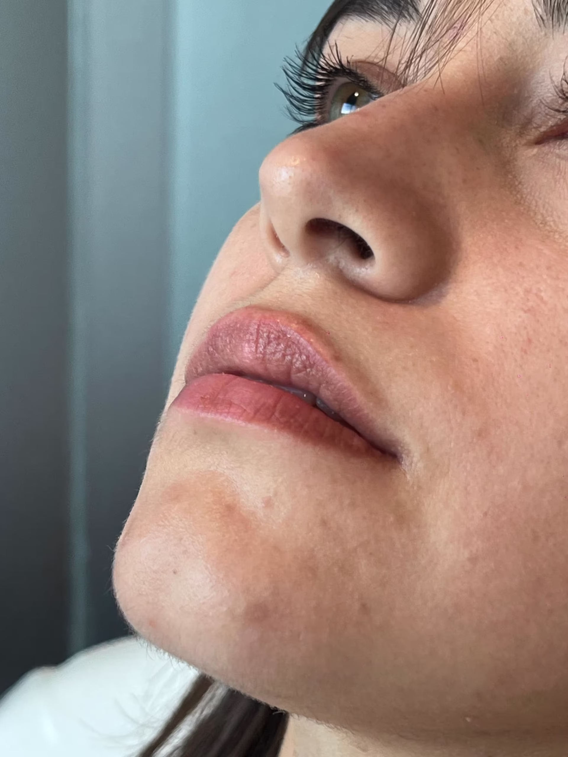 relleno de labios con ácido hialurónico antes