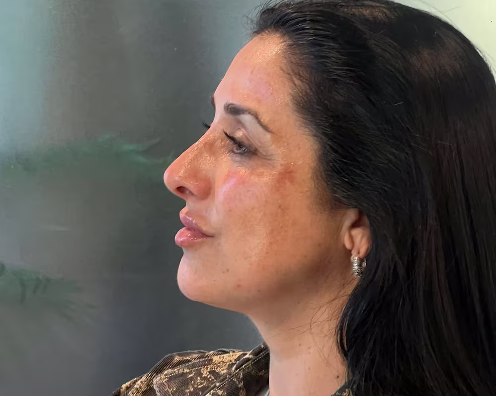 bioestimulación facial con hidroxiapatita de calcio