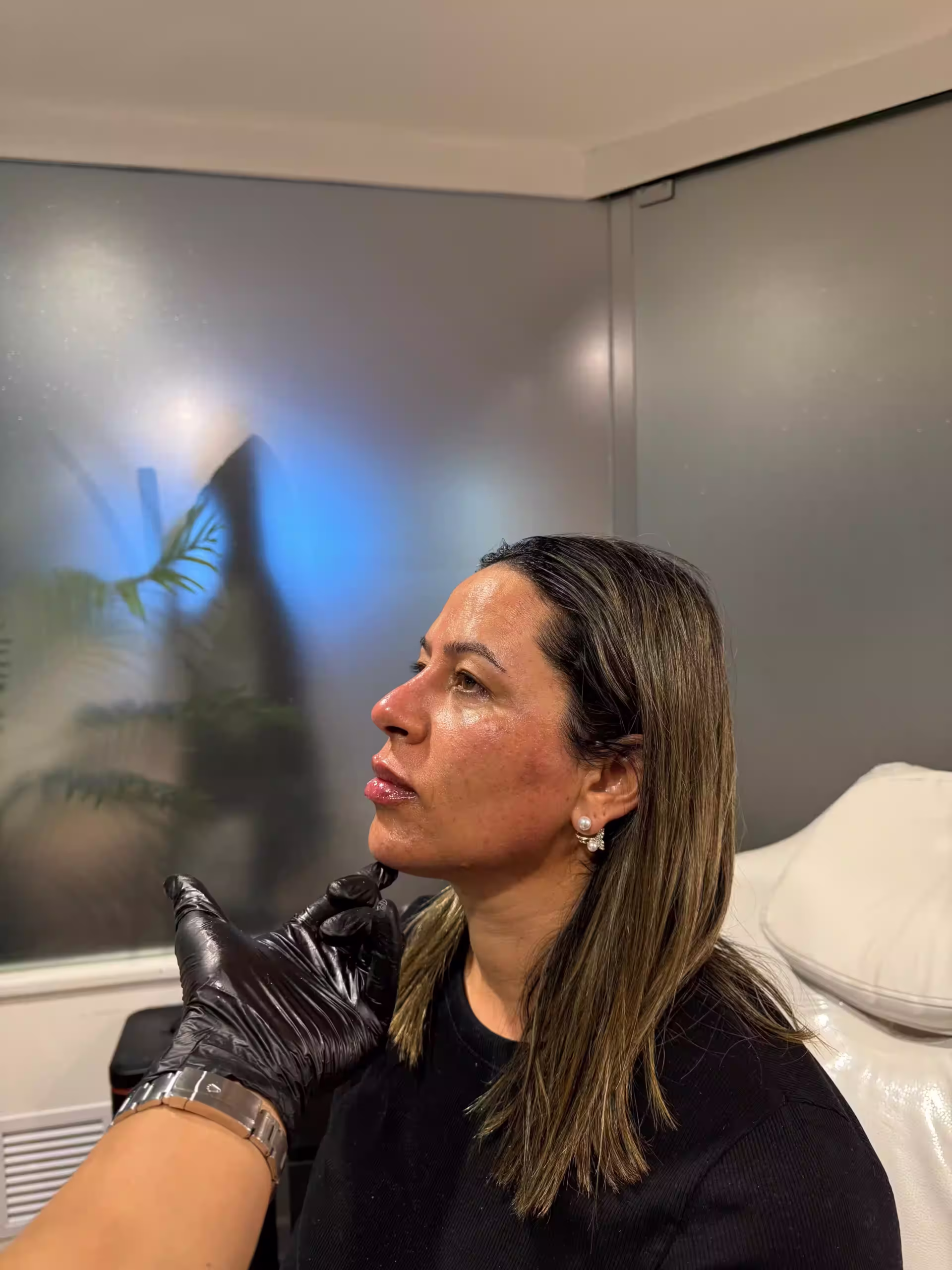 Despues Bioestimulación